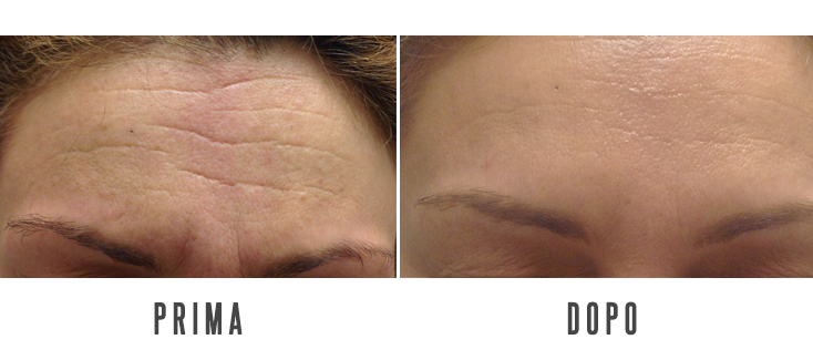 PREVENZIONE DELL'INVECCHIAMENTO CUTANEO E CORREZIONE DELLE RUGHE